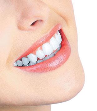 teeth whiten cost